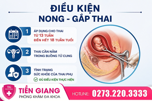 Điều kiện thực hiện nong - gắp thai an toàn.