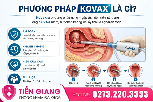 Phương pháp Kovax là gì?