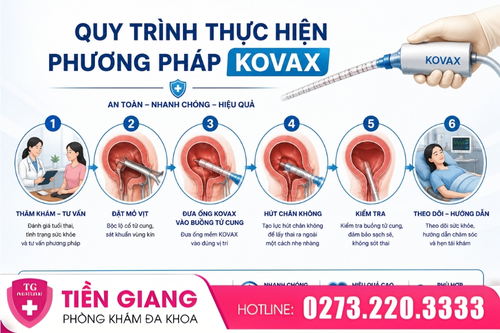 Quy trình phá thai bằng phương pháp Kovax